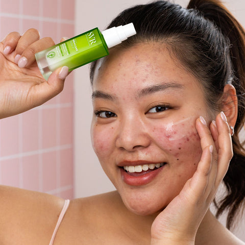 Smiling woman applying SVR Sebiaclear anti-imperfection serum to her face with visible acne breakouts.