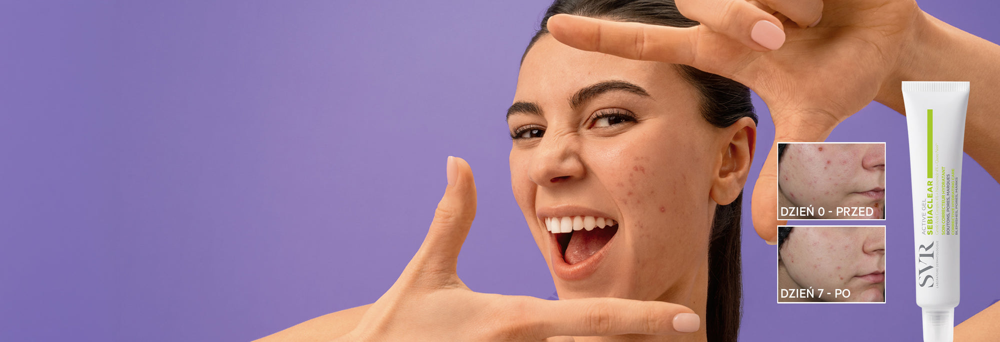 Smiling woman framing her face against a purple background next to SVR Sebiaclear acne treatment before and after results.