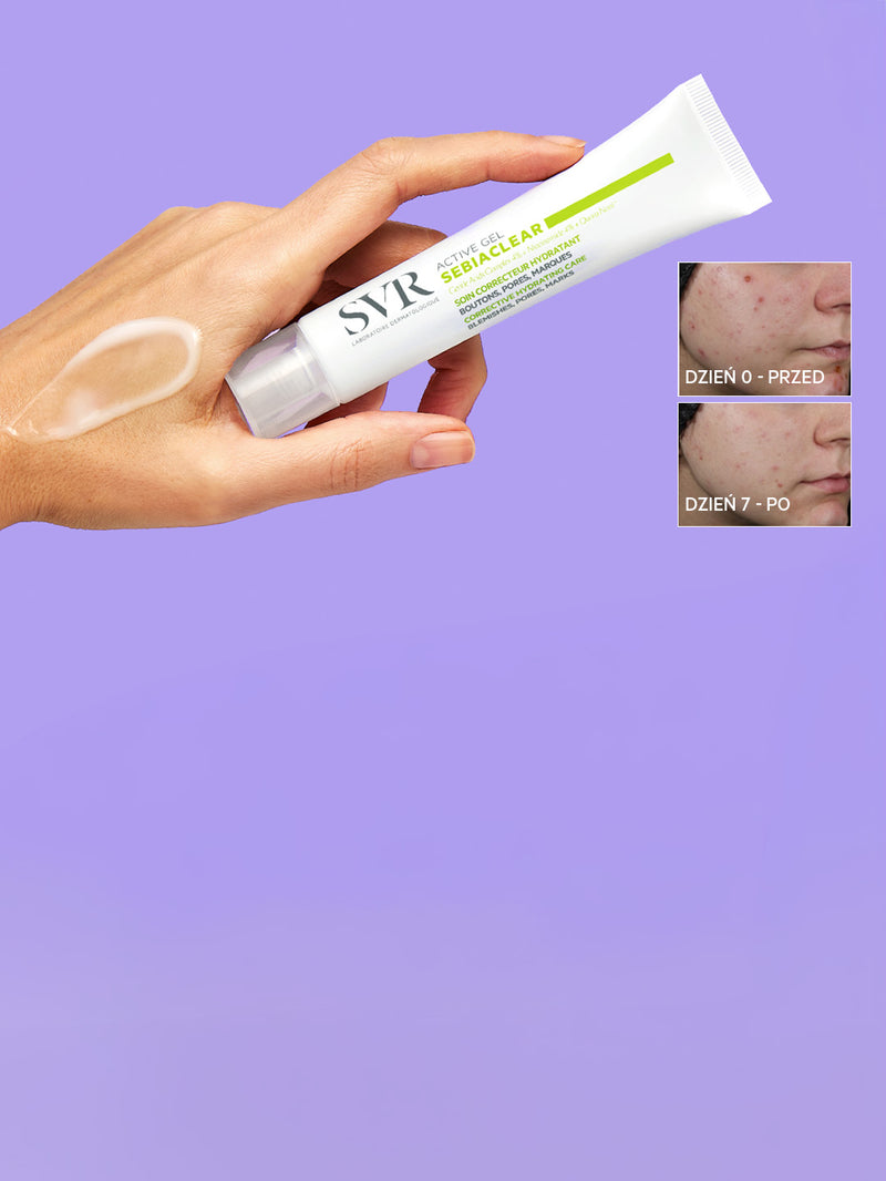 Hand holding SVR Sebiaclear Active Gel tube with a gel swatch and before-and-after skin treatment results on purple background.
